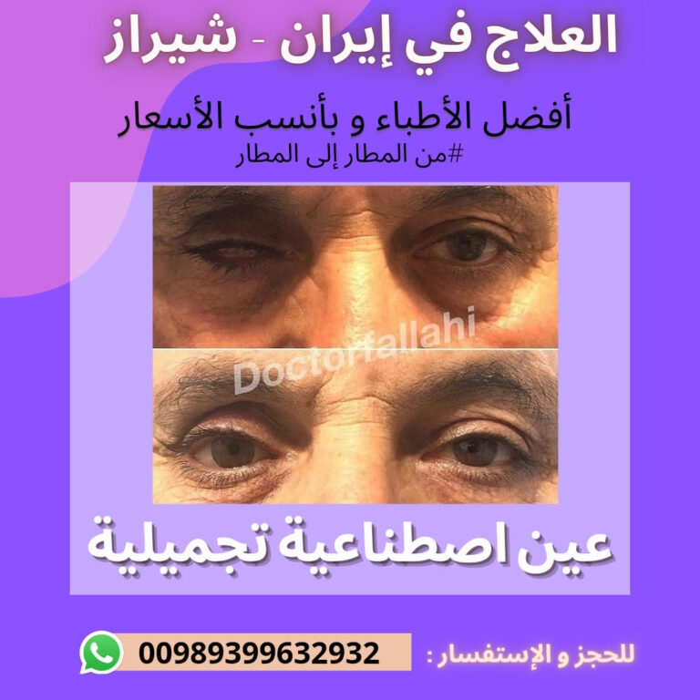 تركيب عين اصطناعية في ايران