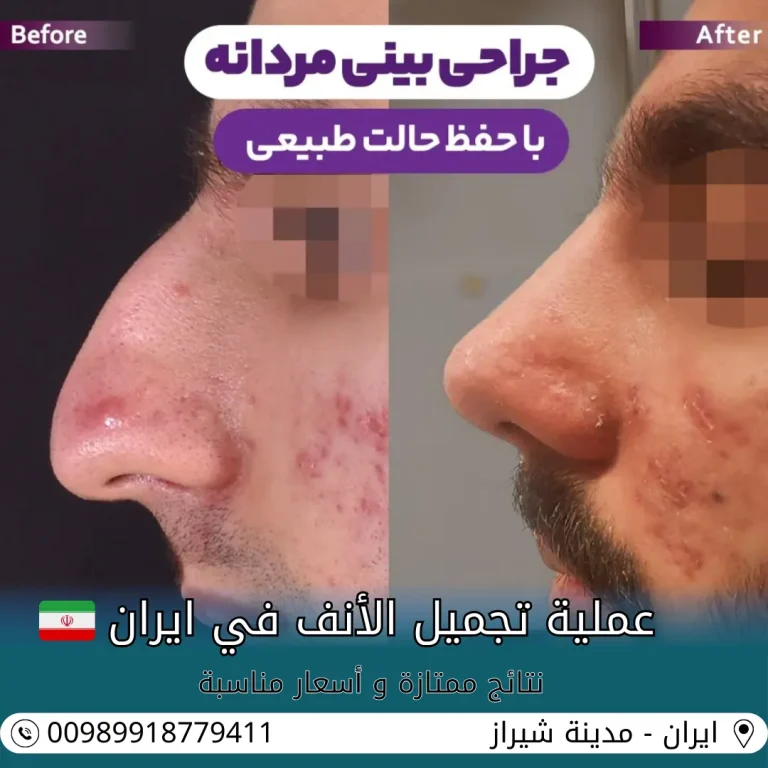عملية تجميل الانف في ايران شيراز