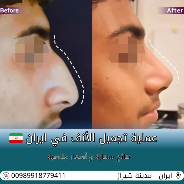 افضل طبيب تجميل انف في ايران