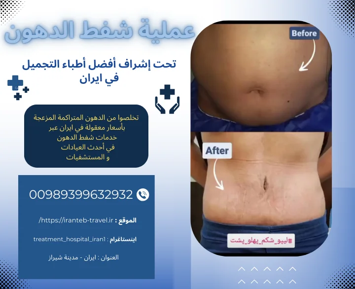 شفط الدهون في ايران
