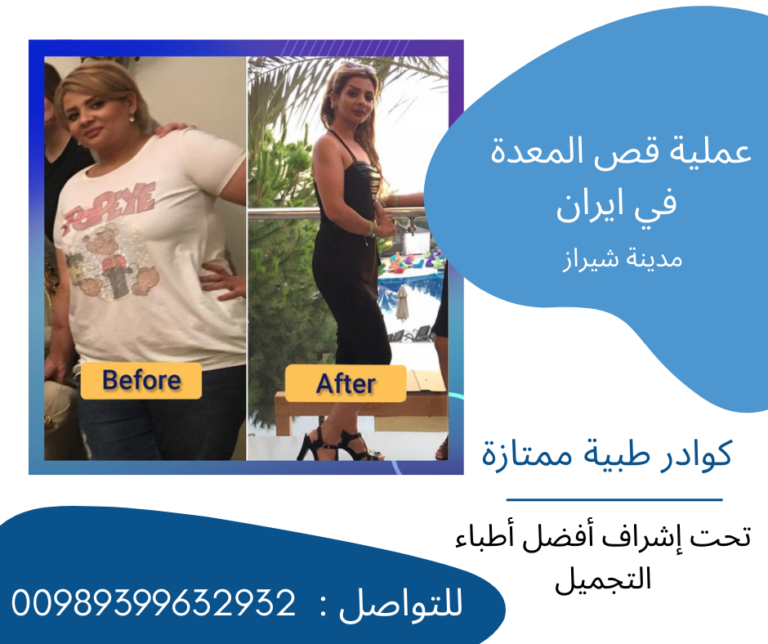 تكلفة عملية قص المعدة في ايران