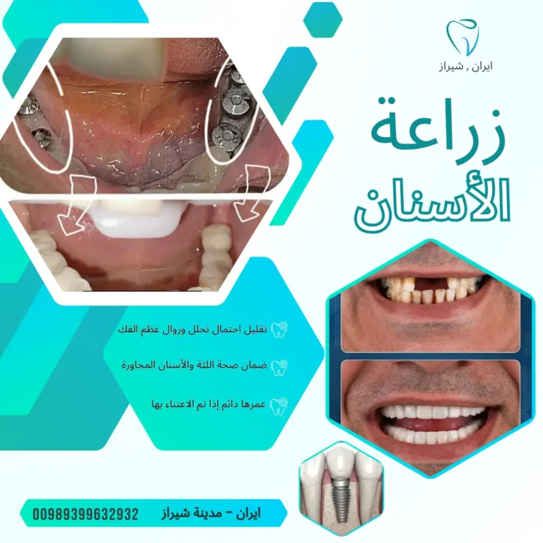 زراعة الأسنان في ايران شيراز