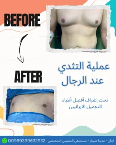 عملية تجميل الثدي في ايران شيراز