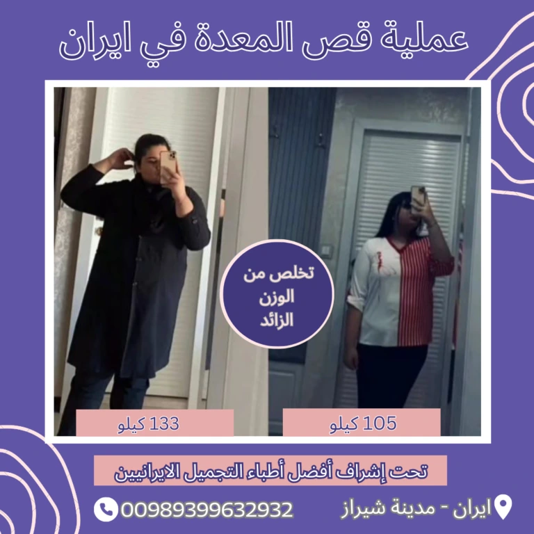 تكلفة عملية تكميم المعدة في ايران