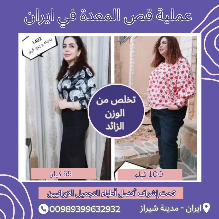 تكلفة عملية قص المعدة في ايران