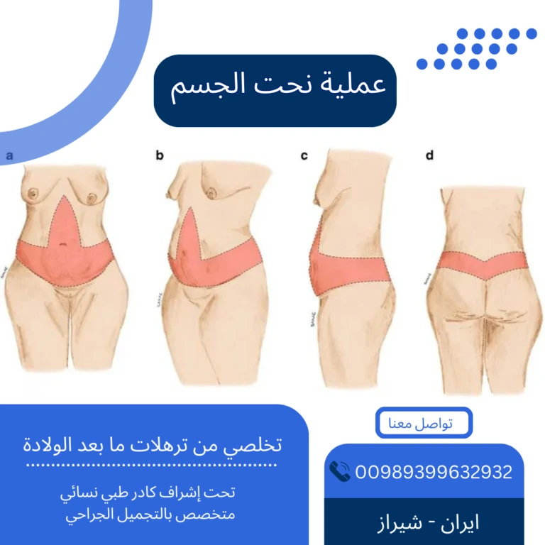 عملية شفط الدهون في ايران