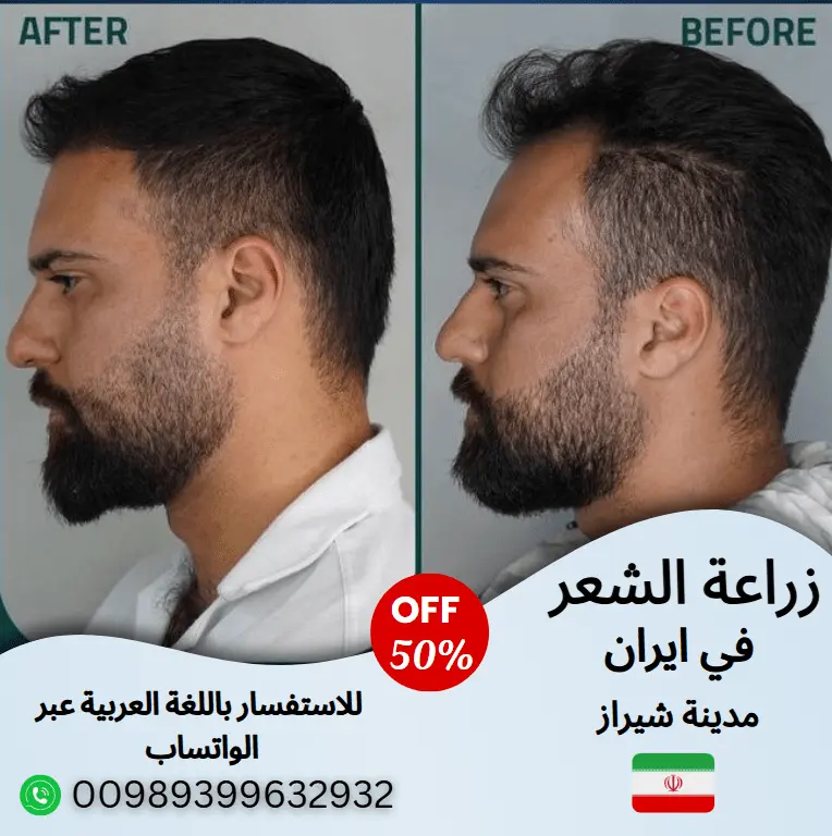افضل-مركز-زراعة-شعر-في-شيراز
