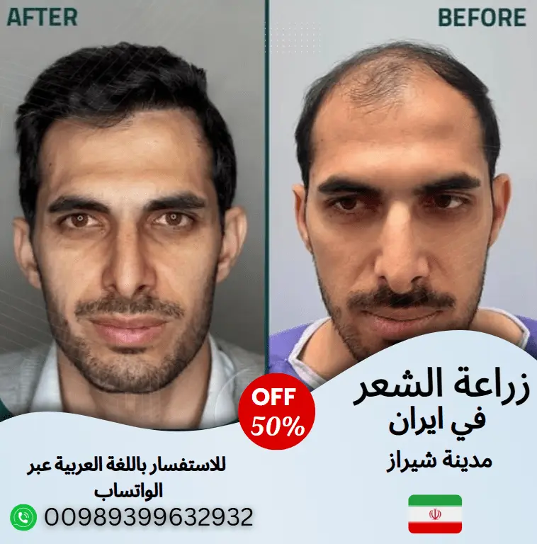 افضل-مركز-لزراعة-الشعر-في-ايران