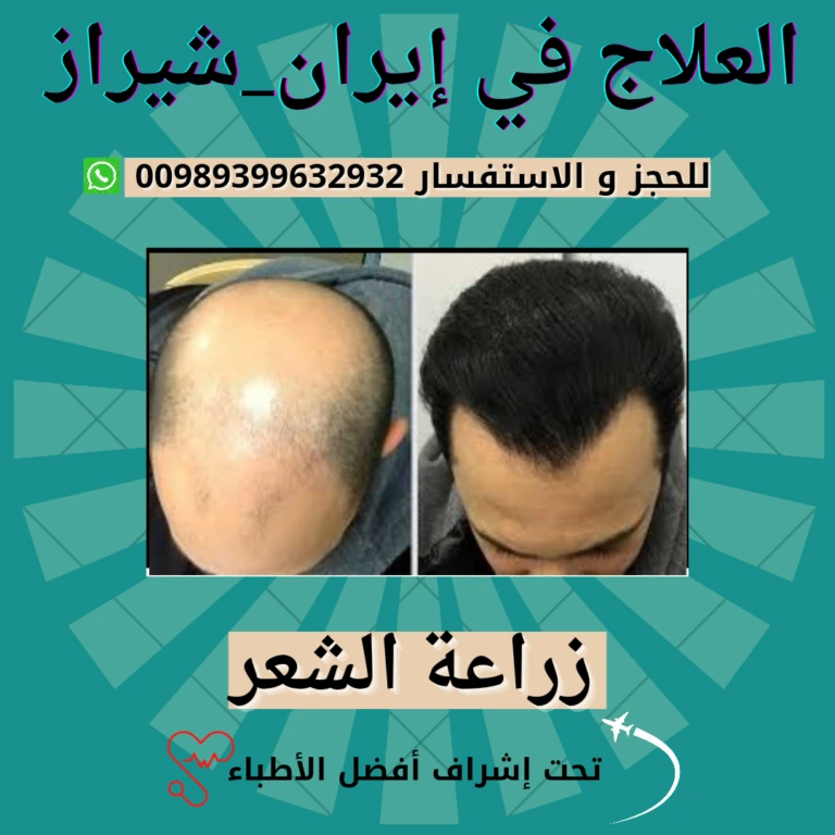 تكلفة زراعة الشعر في ايران