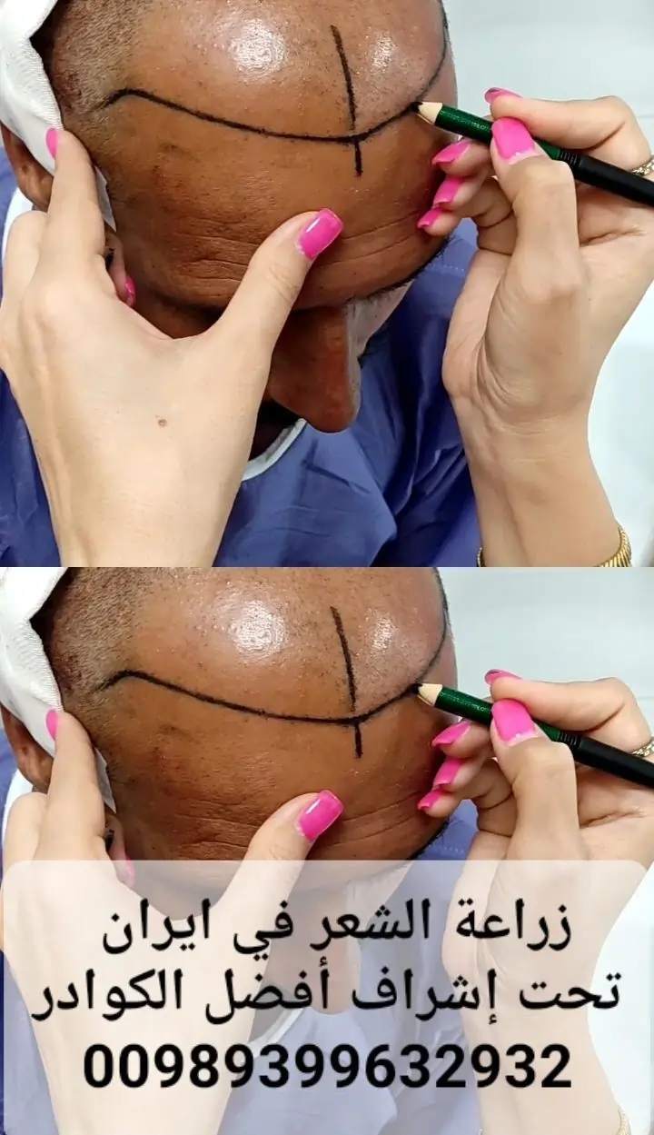 تكلفة زراعة الشعر في شيراز
