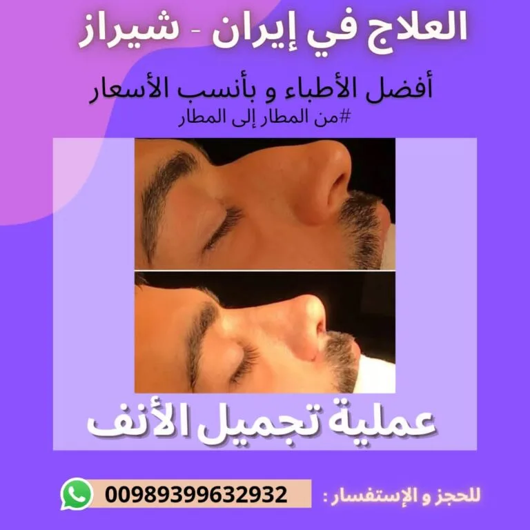 تكلفة عملية تجميل الانف في ايران