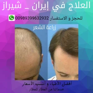 زراعة الشعر في ايران