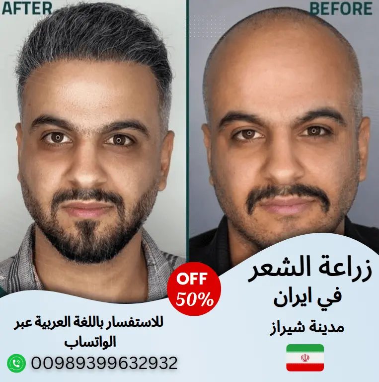 زراعة-الشعر-في-ايران-شيراز