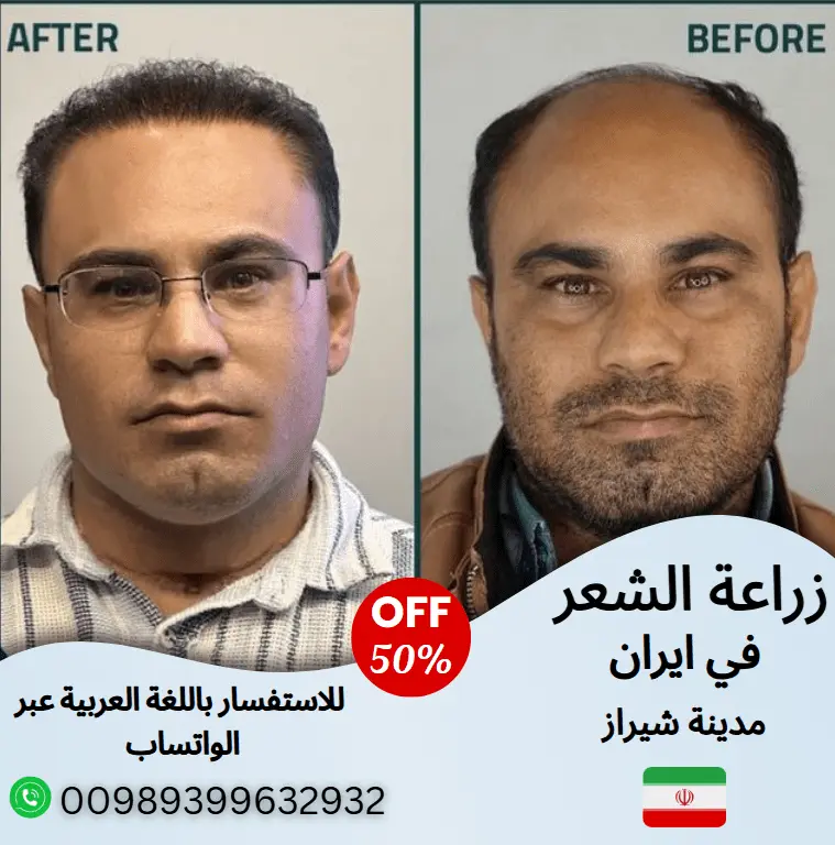 زراعة-الشعر-في-ايران