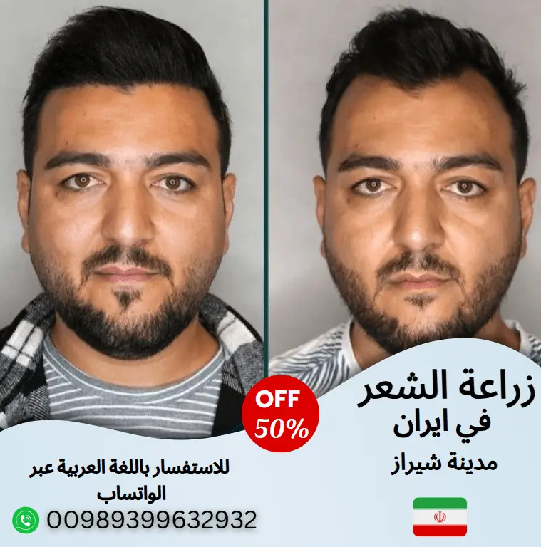 زراعة-الشعر-في-شيراز