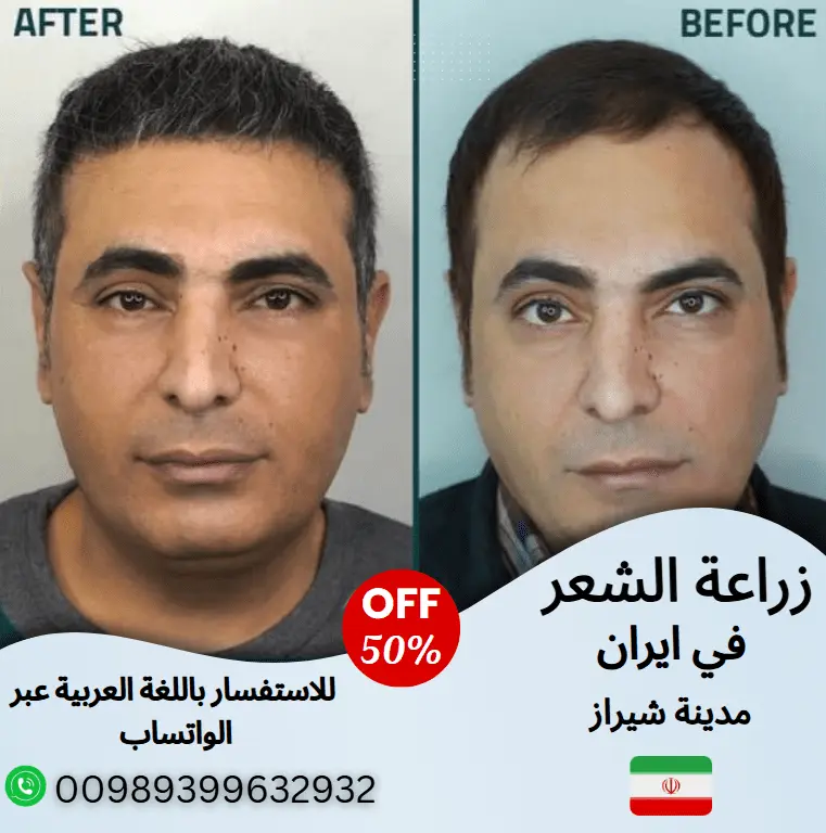 زراعة-الشعر-للنساء-في-ايران