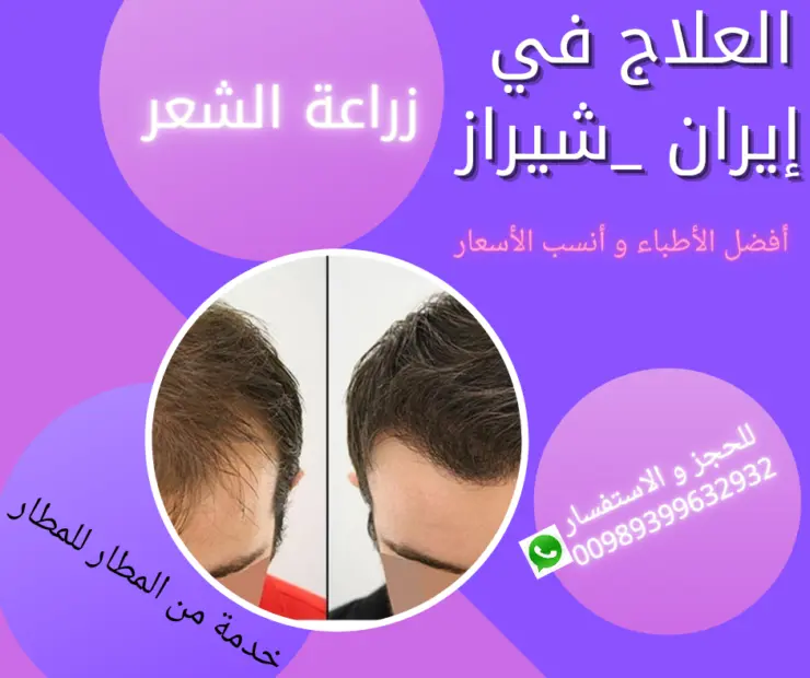 زرع الشعر في ايران