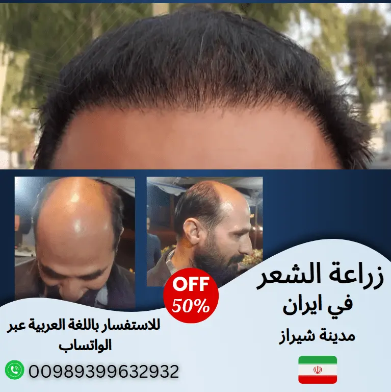 مراكز-زراعة-الشعر-في-طهران