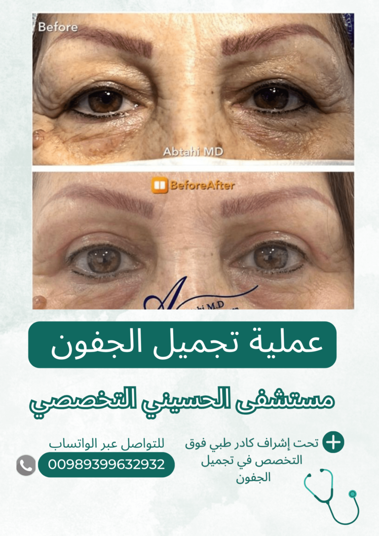 عملية قص الجفون في ايران
