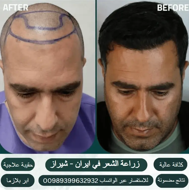 افضل-مركز-لزراعة-الشعر-في-ايران