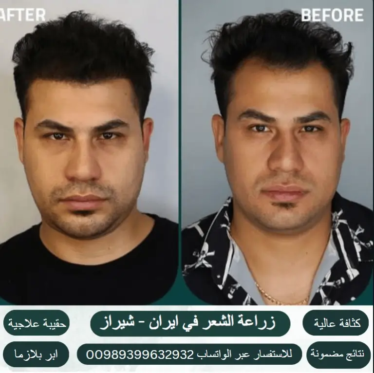 زراعة-الشعر-ايران