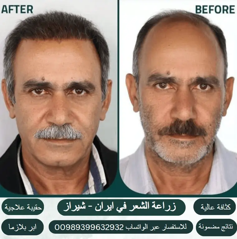 زراعة-الشعر-في-ايران