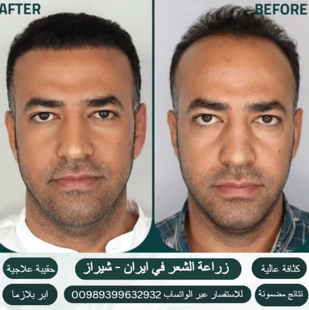زراعة الشعر في ايران
