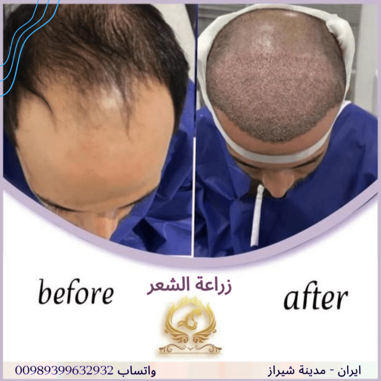 زراعة الشعر في شيراز