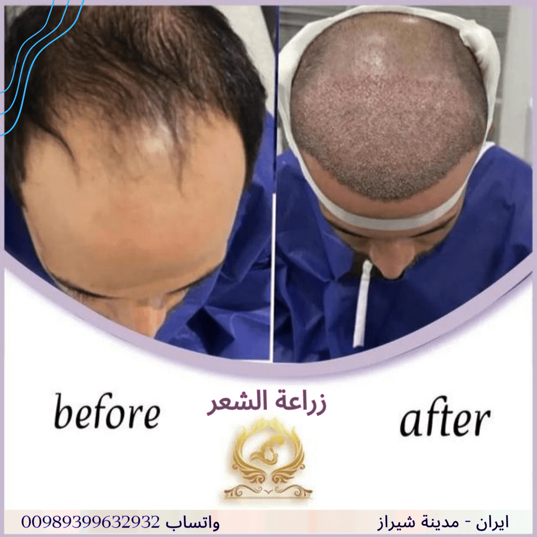 زراعة الشعر في شيراز