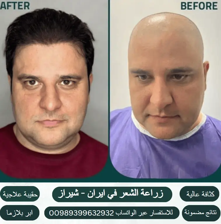 عملية-زراعة-الشعر-في-ايران