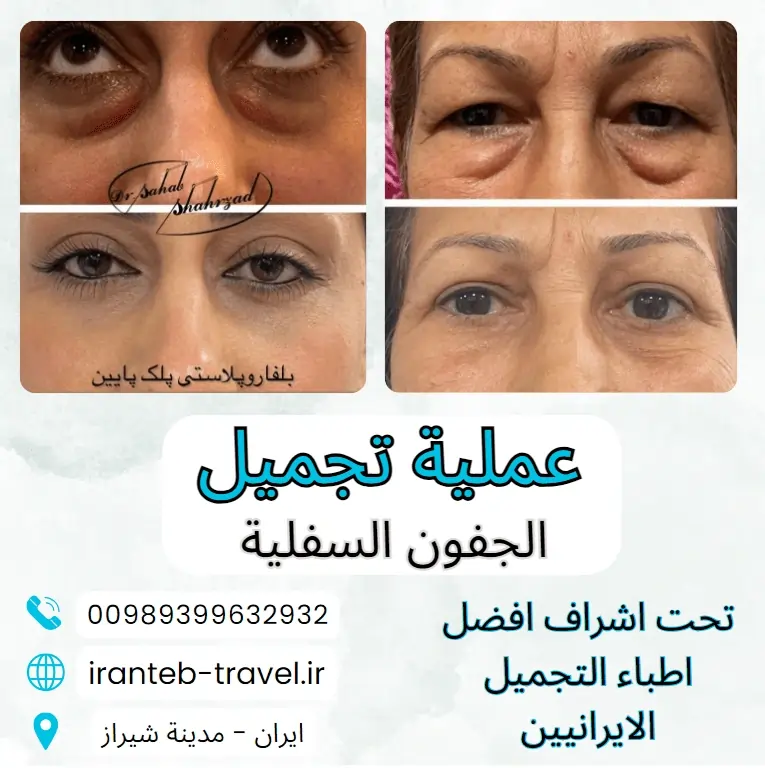 عملية-شد-الجفون-في-ايران
