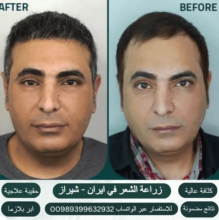 مراكز-زراعة-الشعر-في-ايران