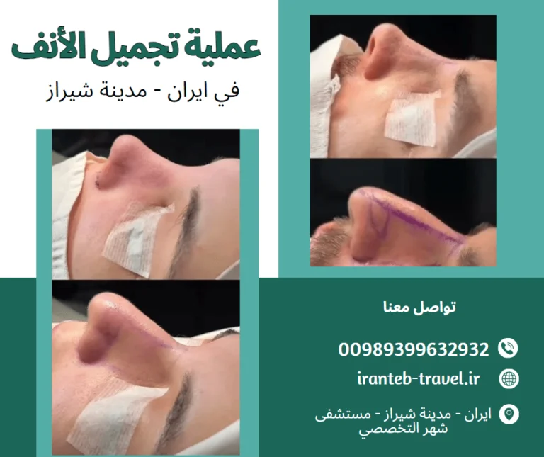 تجميل-الانف-في-ايران