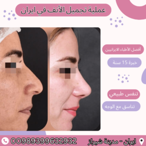 تجميل الانف في ايران