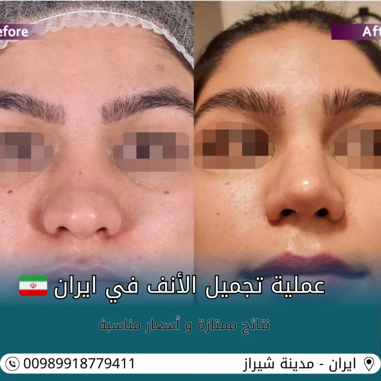 تجميل الانف في ايران