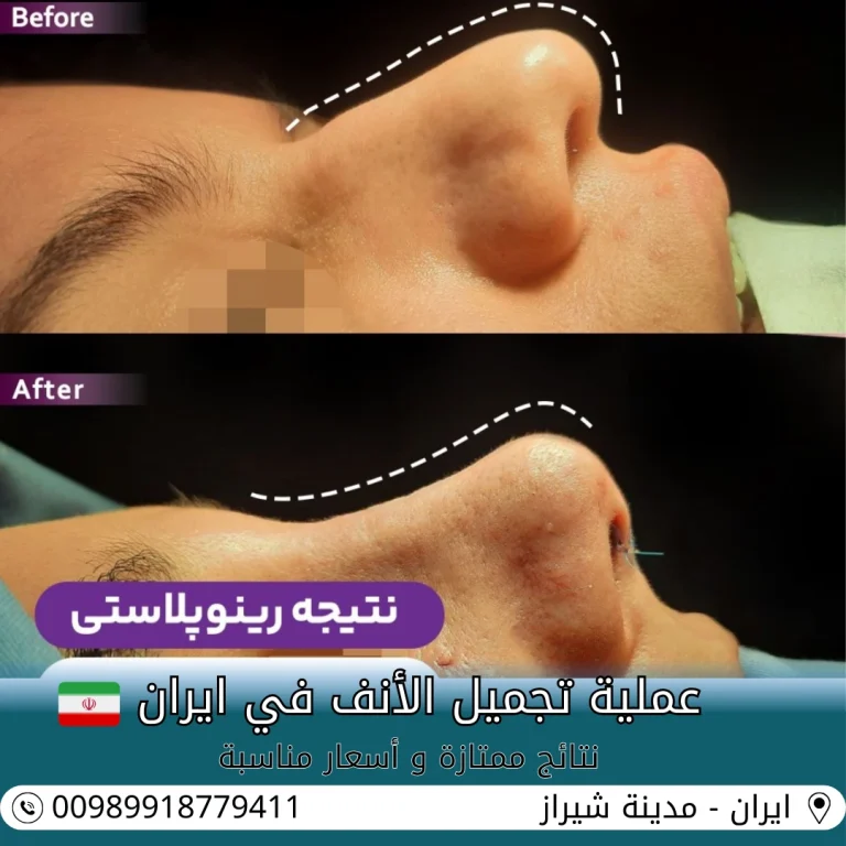 تكلفة تجميل الانف في ايران