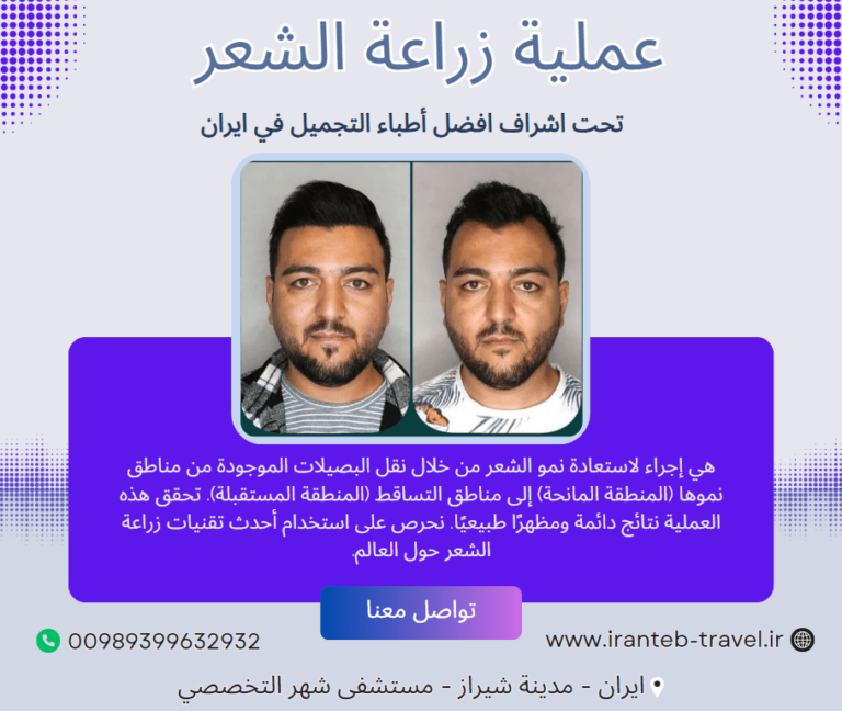 زراعة الشعر في ايران