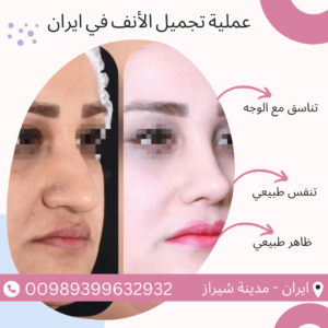 سعر عملية تجميل الأنف في إيران