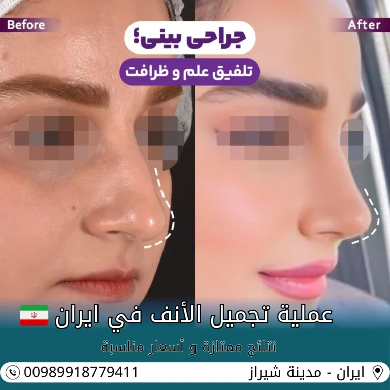 عملية تجميل الانف في ايران