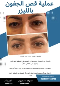 عملية شد الجفون في ايران