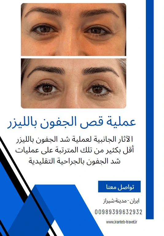 عملية قص الجفون في ايران