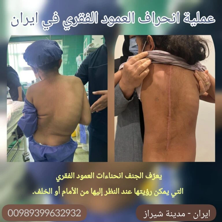 عملية انحراف العمود الفقري في ايران