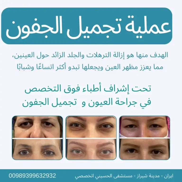 عملية تجميل الجفون في ايران