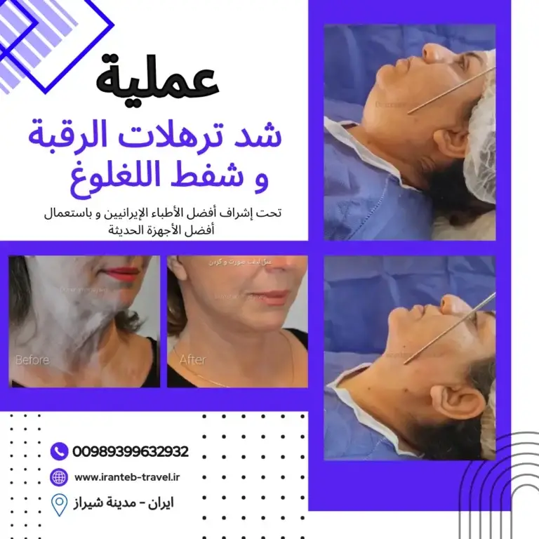 عملية شد الرقبة في ايران