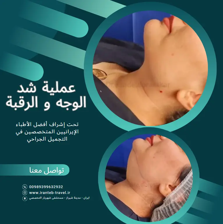 عملية شد الوجه في ايران