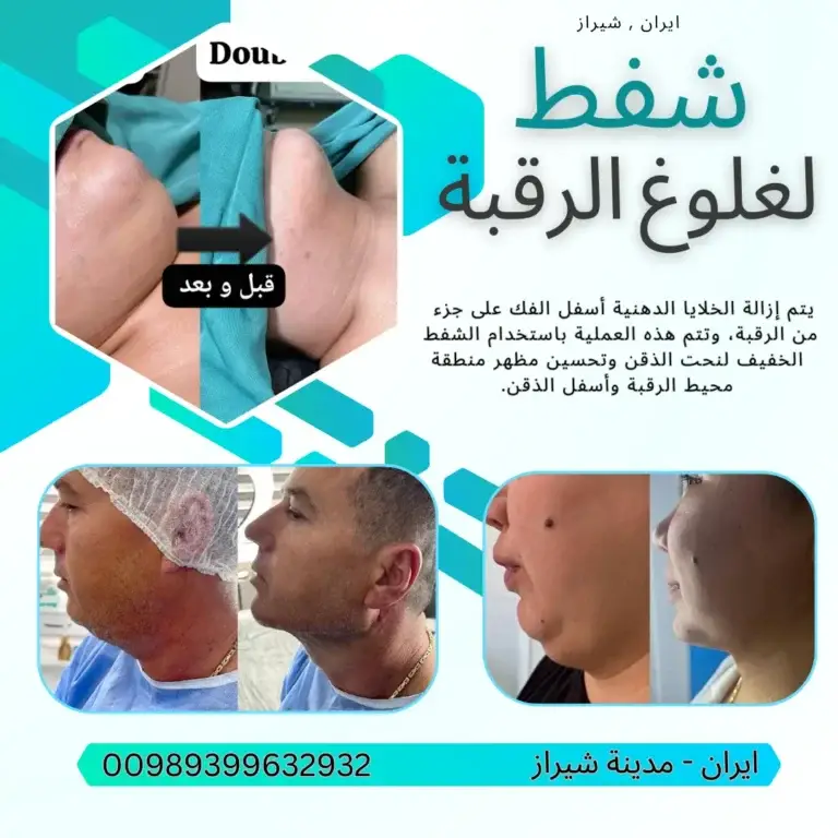 عملية شفط لغلوغ الرقبة في ايران