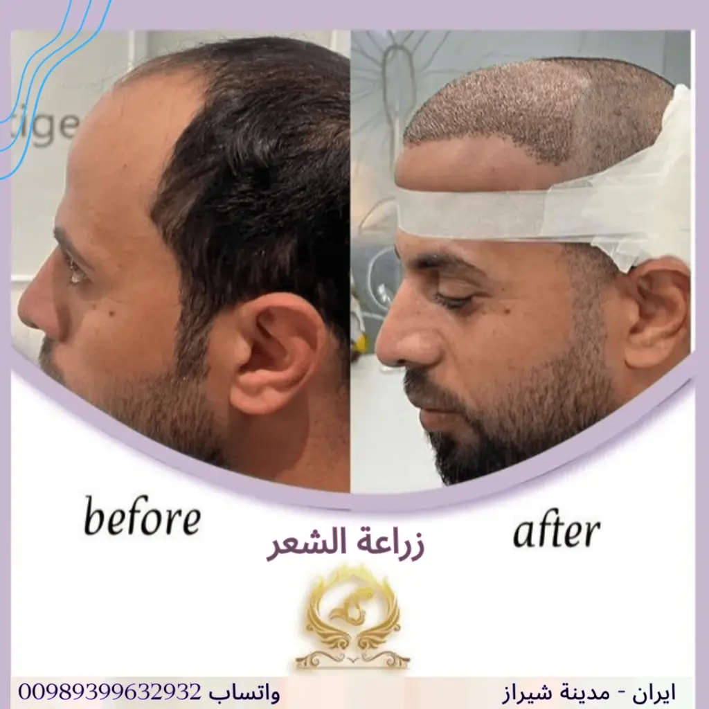 افضل مركز زراعة الشعر في شيراز