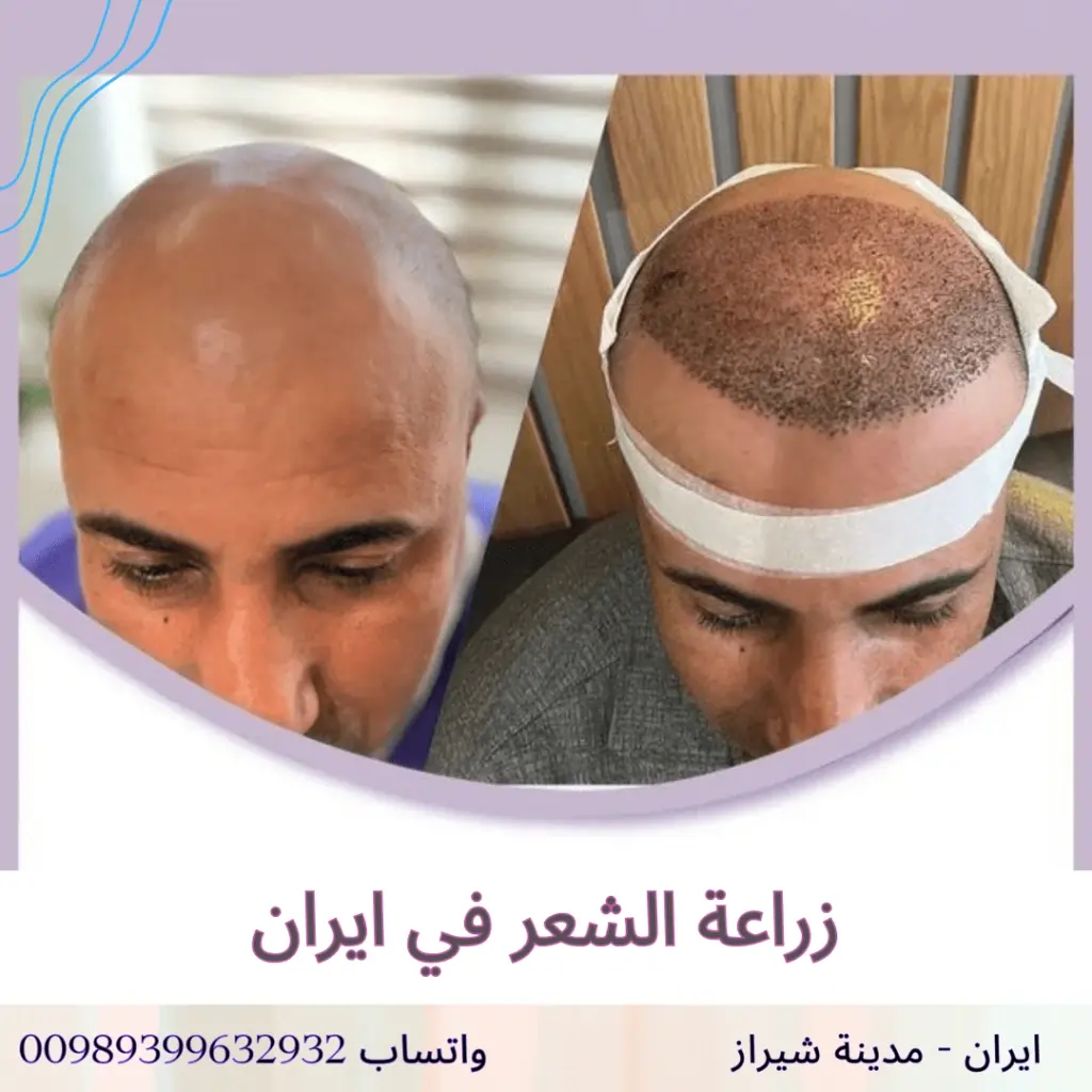 زراعة الشعر في شيراز
