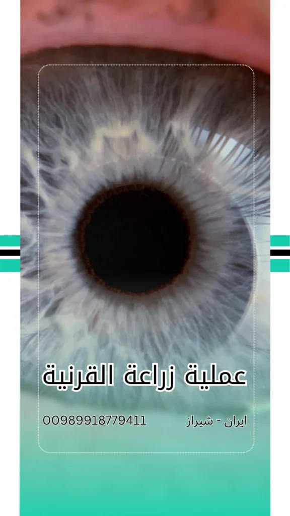 عملية زرع القرنية في ايران