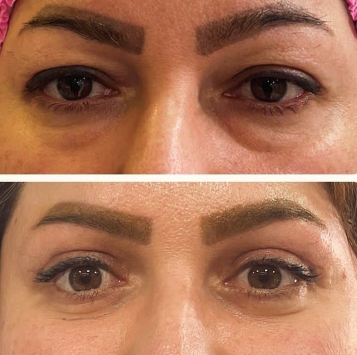تجميل الجفون في ايران